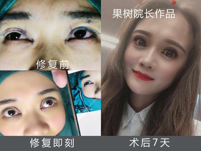 来自北京的美女全切双眼皮失败修复，7天反馈修复完美(图1)
